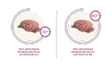 massa cerebrale adulta